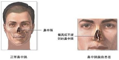 精囊炎