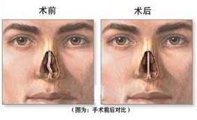 精囊炎